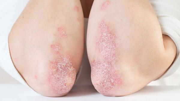 حشره کش نانو پوست بدن را در برابر انگل ها محافظت می کند